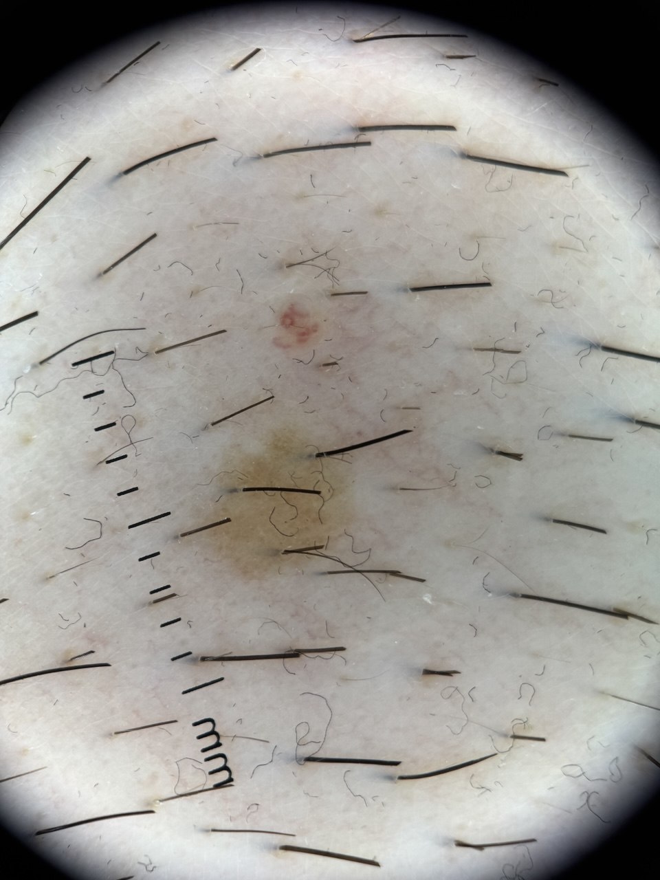 Dermatoscopic capture of a faint lesion on pale skin