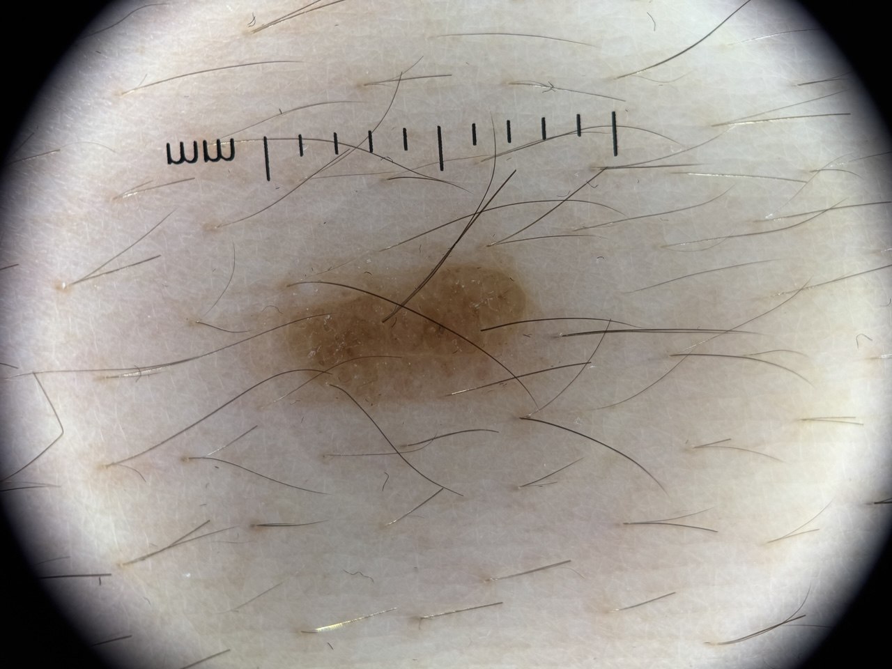 Dermatoscopic capture of a brown mole on hair-covered skin