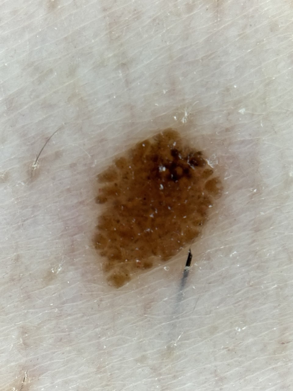 Close-up dermatoscopic capture showing the pigment network of a mole