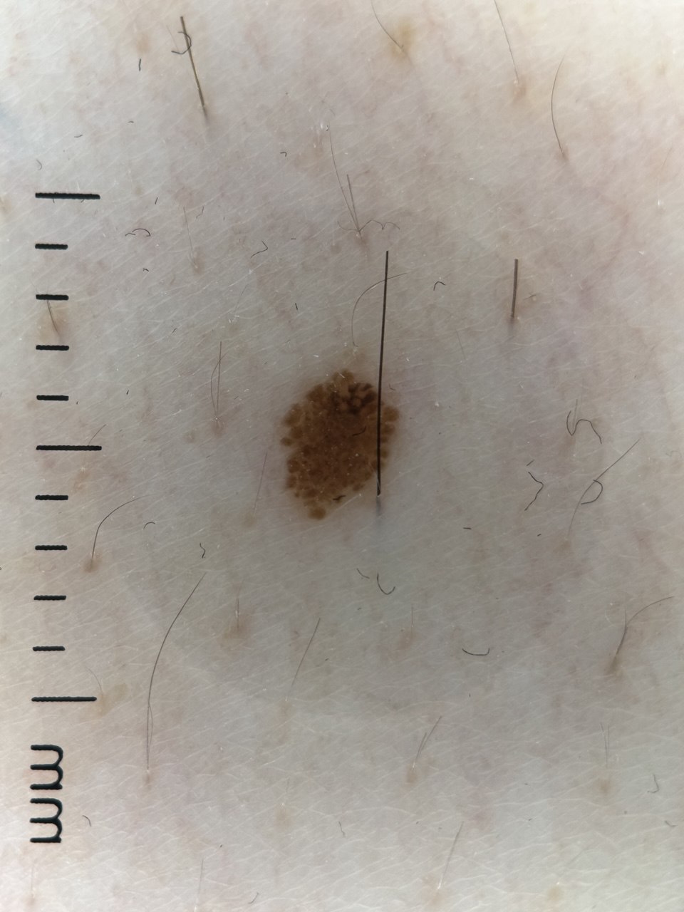 Dermatoscopic capture of a pigmented mole next to a millimetre scale