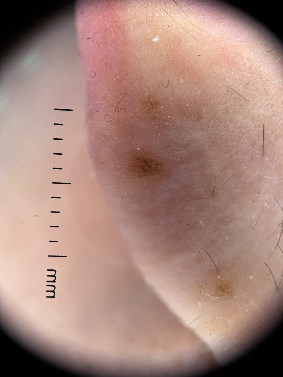 Dermatoscopic capture of several small spots across an area of skin