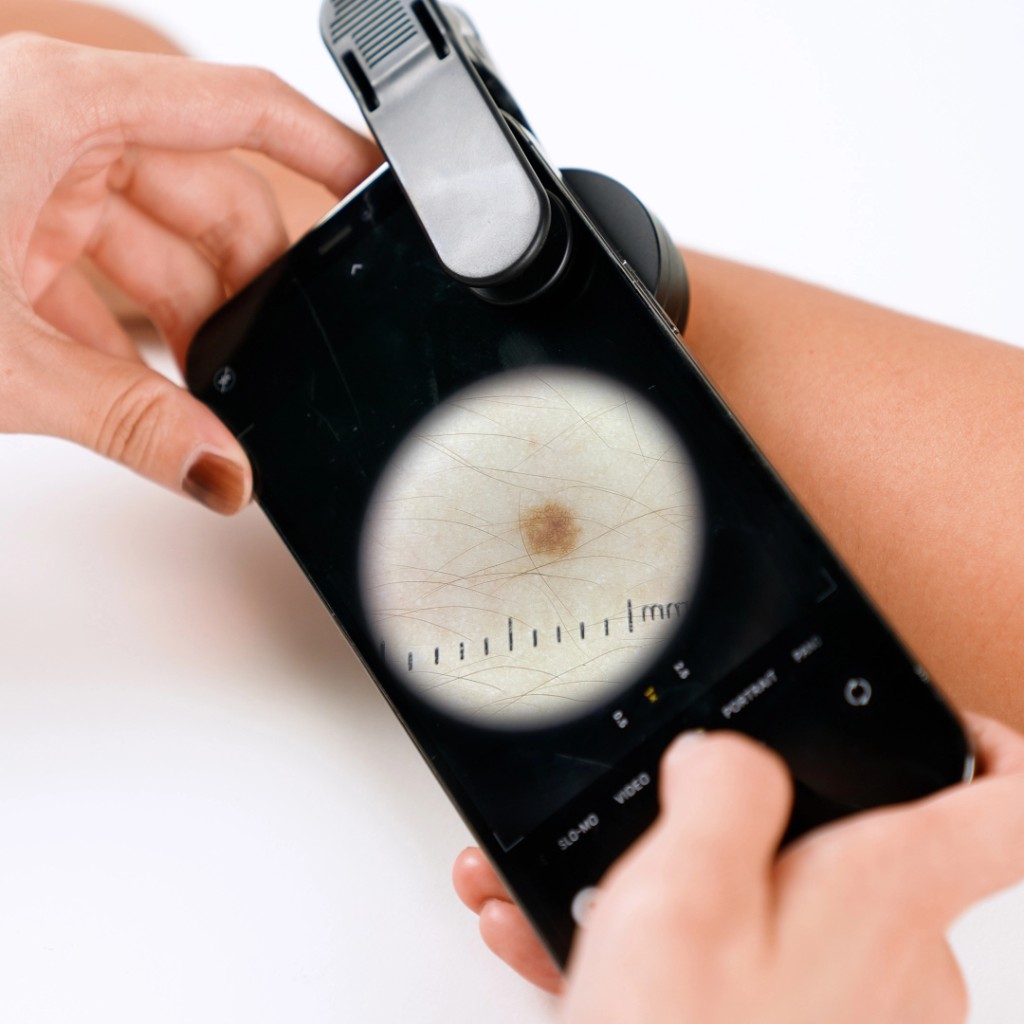 Professional skin examination using Jeskin lens on a phone